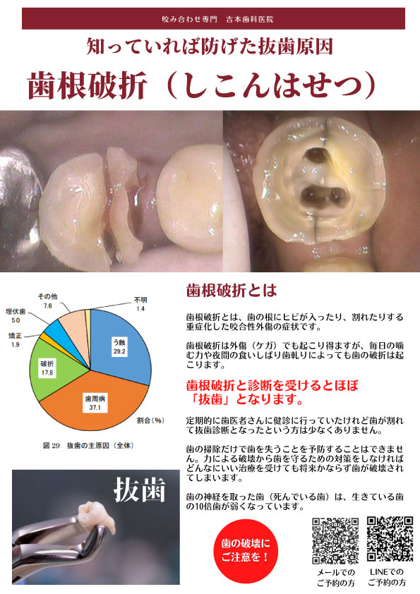 歯根破折で抜歯｜いつ起こるかわからない歯の破折の予防｜香川県の吉本歯科医院